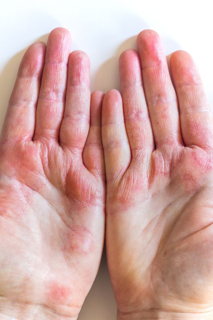 Dermatitis: What You Need to Know