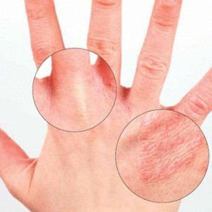 How to Treat Dry Hands – Beauty Tips